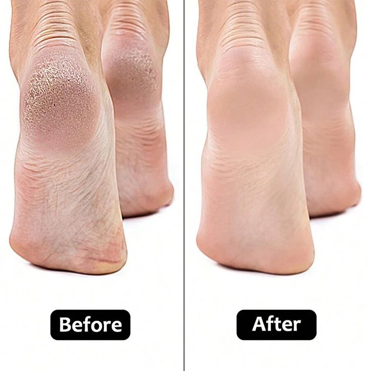 Sole Healer™ SmoothCare Foot Reviver
